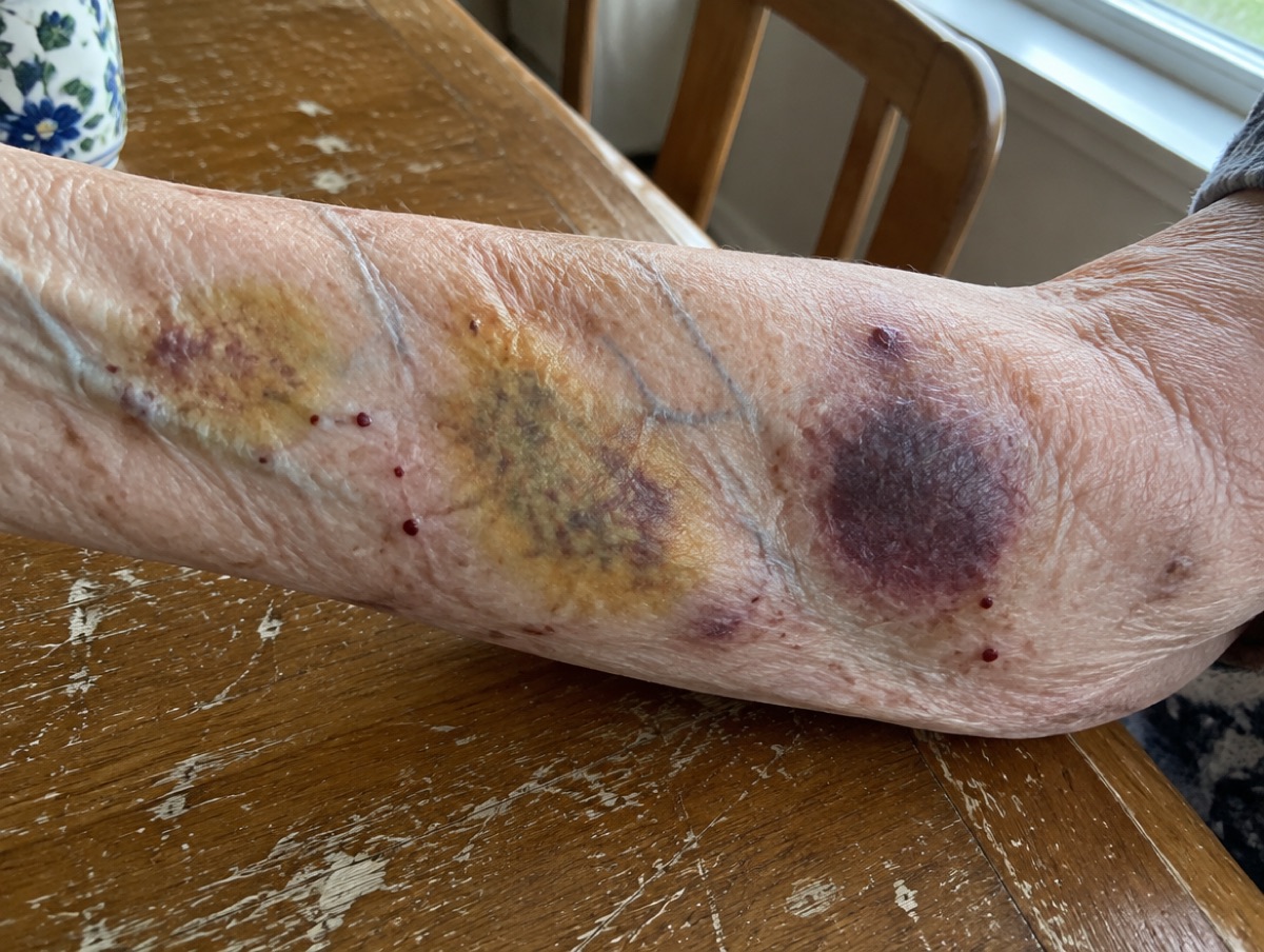 Day 1: forearm of a 71-year-old woman with several large purple and yellow-green bruises on paper-thin skin
