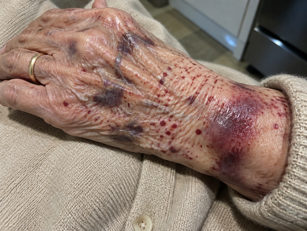 Back of a 71-year-old woman's left hand covered in flat dark purple patches and small red blood spots